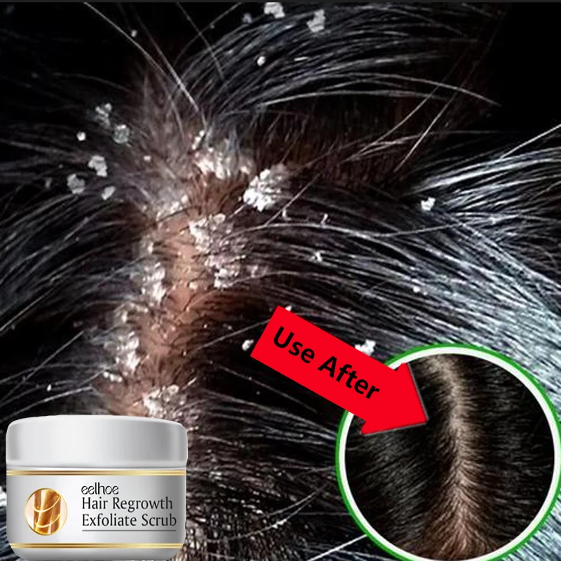 Scalp Scrub Exfoliant - Fast Anti Dandruff Hair Treatment Scrub