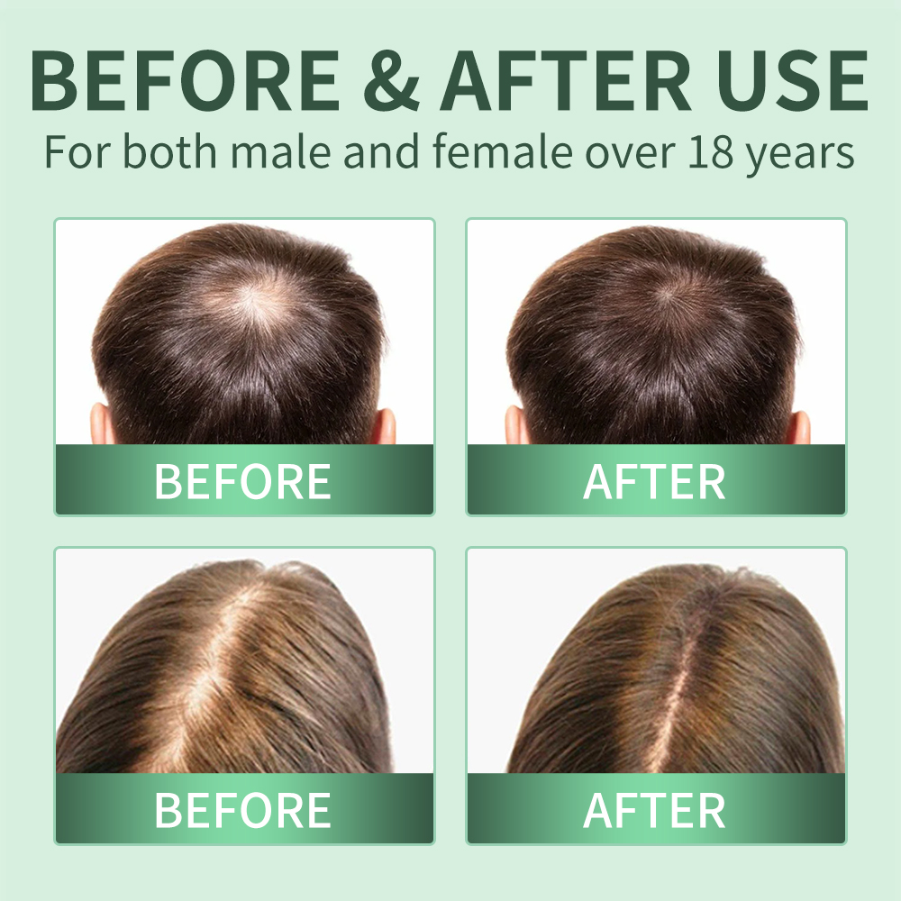 Hair Growth Spray,Scalp Scrub, - Scalp Scrub Exfoliant recension och pris