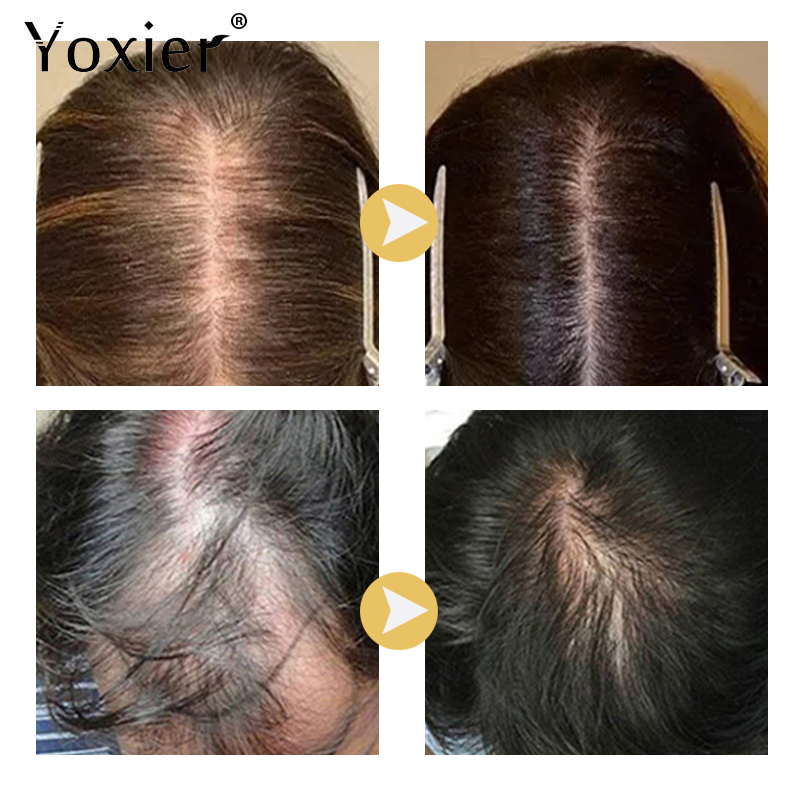 Intensive Growth Serum Prevent - Hair Care For Hair Loss recension och pris