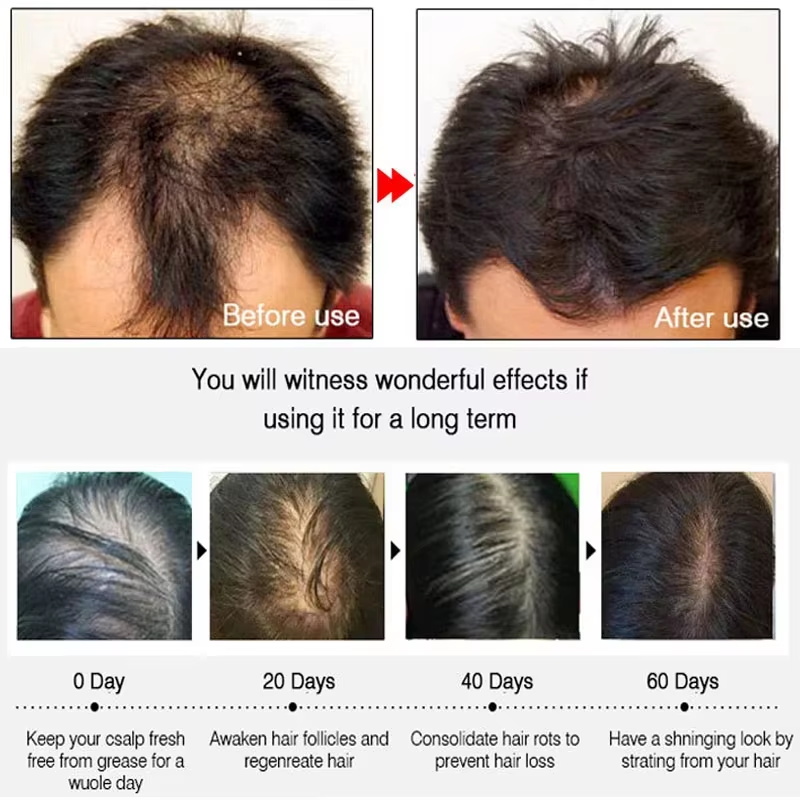 Fast Ginger Hair Growth Spray  - Hair Care For Hair Loss recension och pris